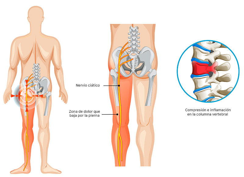 dolor lumbar o ciática: ciática