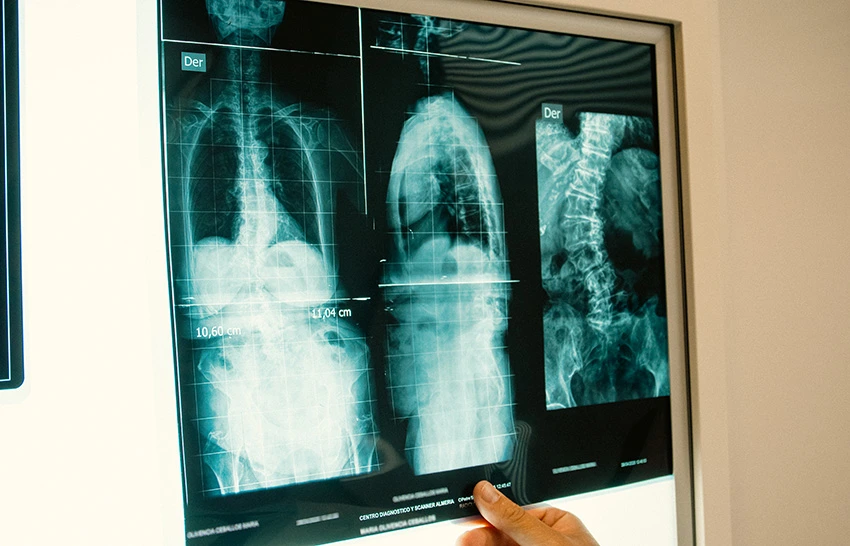 Escoliosis en adultos: cómo detectarla y mejorar tu calidad de vida 