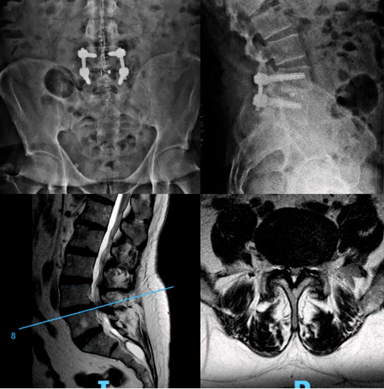 artrodesis lumbar radiografía