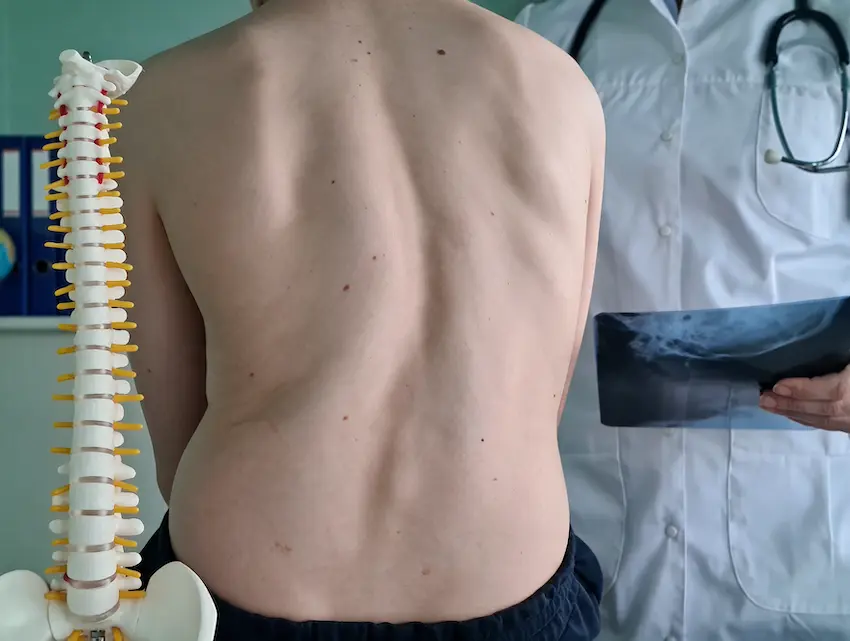 Escoliosis degenerativa qué es, síntomas y cuándo consultar